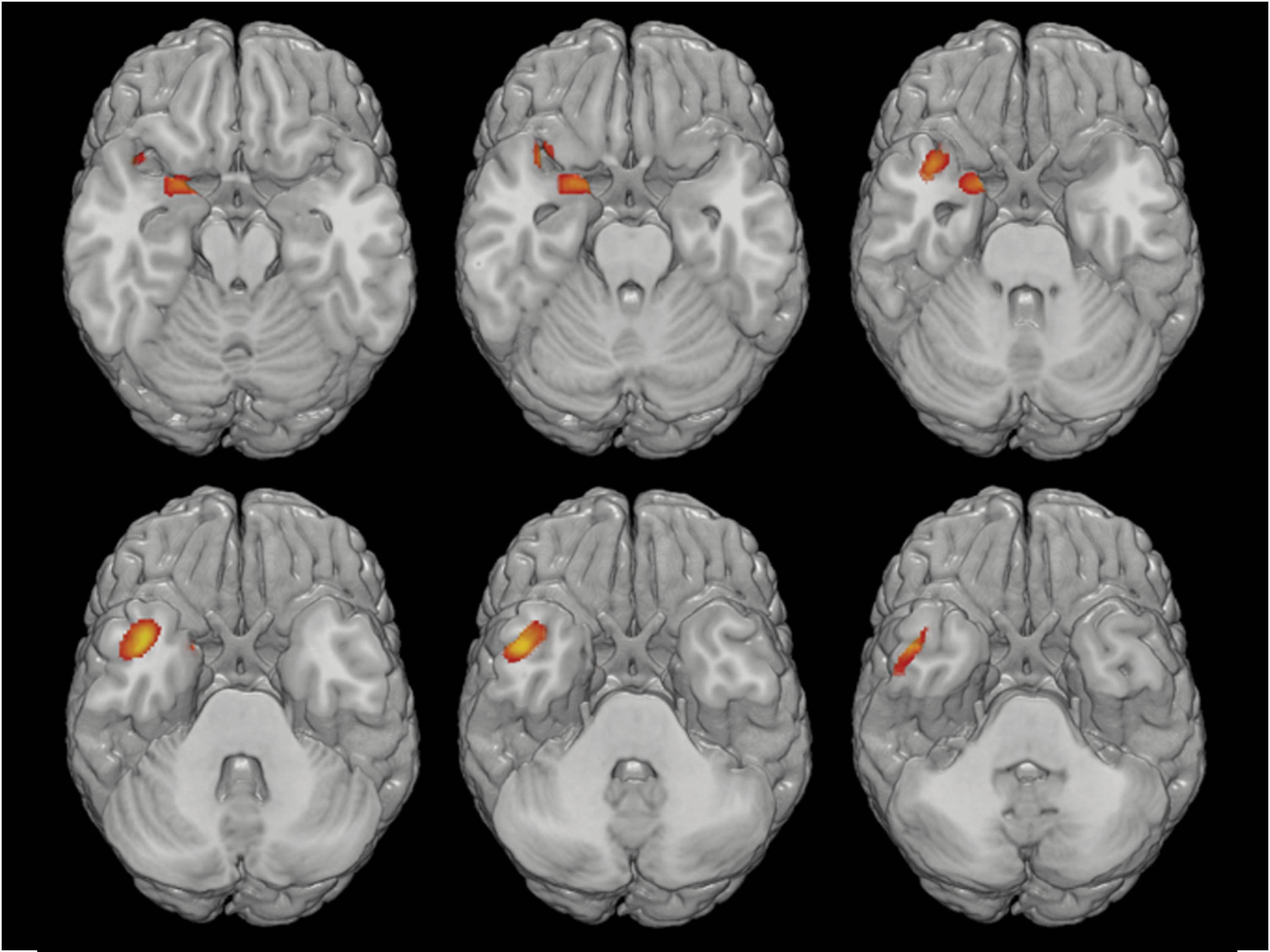 Relacionan el recuento de neutrófilos en sangre con la pérdida de tejido cerebral en enfermedades mentales