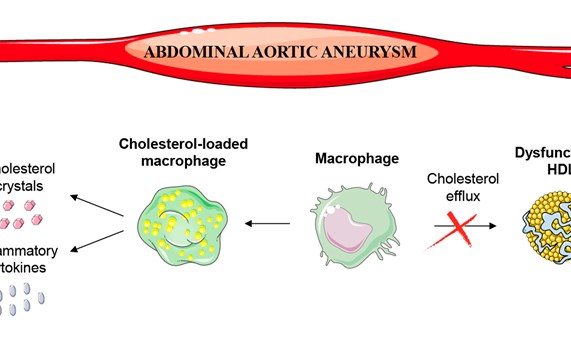 Las lipoproteínas que transportan el colesterol ‘bueno’ pierden su capacidad cardioprotectora en pacientes con aneurisma aórtico abdominal
