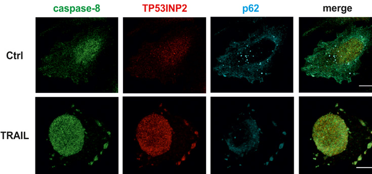 Identifican un nuevo biomarcador para realizar tratamientos personalizados contra el cáncer
