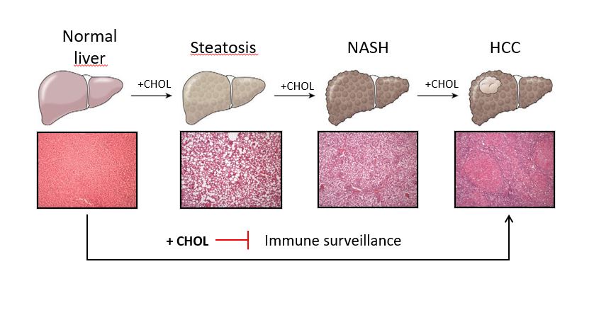 Revelan un papel clave del colesterol pero no de la esteatosis en el desarrollo del carcinoma hepatocelular