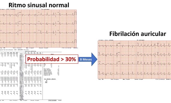 Análisis de electrocardiogramas con big data para predecir el riesgo de fibrilación auricular Análisis de electrocardiogramas con big data para predecir el riesgo de fibrilación auricular