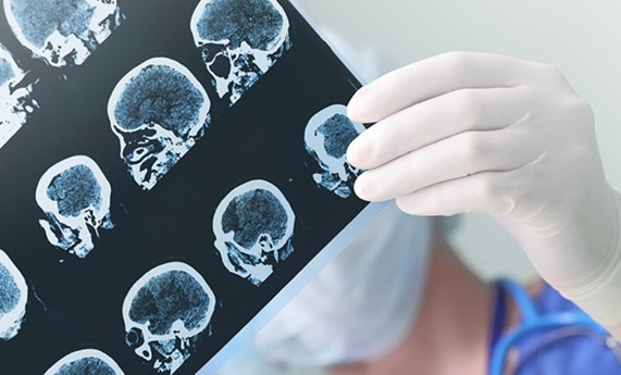 La falta de proteína priónica celular podría provocar síntomas de epilepsia y déficits de aprendizaje La falta de proteína priónica celular podría provocar síntomas de epilepsia y déficits de aprendizaje