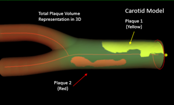 La ecografía vascular en 3D matrix identifica con precisión el daño cardiovascular en personas sanas La ecografía vascular en 3D matrix identifica con precisión el daño cardiovascular en personas sanas
