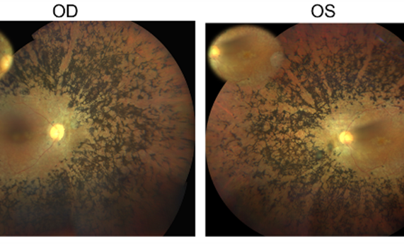 Identifican un nuevo gen candidato de retinosis pigmentaria con una estrategia de análisis del genoma completo Identifican un nuevo gen candidato de retinosis pigmentaria con una estrategia de análisis del genoma completo