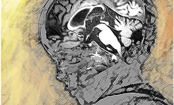 Identifican un gen causante de un nuevo síndrome neurológico y óseo Identifican un gen causante de un nuevo síndrome neurológico y óseo