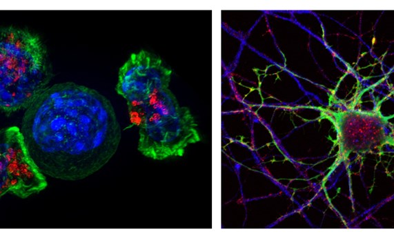 Analizan datos de vida real para mejorar la investigación de la relación entre cáncer y neurodegeneración Analizan datos de vida real para mejorar la investigación de la relación entre cáncer y neurodegeneración