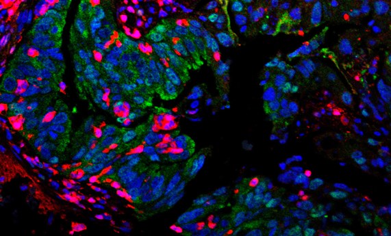 Descubren un conjunto de marcadores de mal pronóstico en pacientes con cáncer de colon y recto Descubren un conjunto de marcadores de mal pronóstico en pacientes con cáncer de colon y recto
