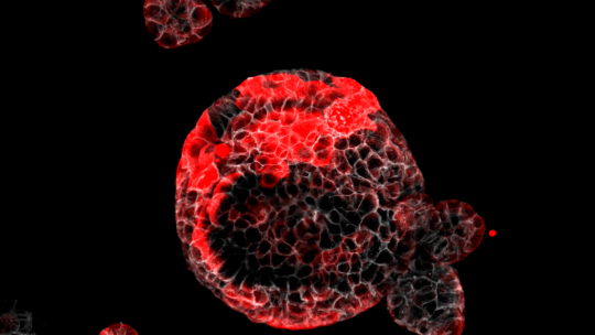 Identificadas las células responsables de la recaída en el cáncer de colon