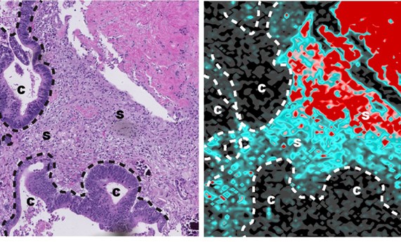 Descubren el mecanismo por el cual las células tumorales se hacen resistentes a la quimioterapia en cáncer de colon y recto